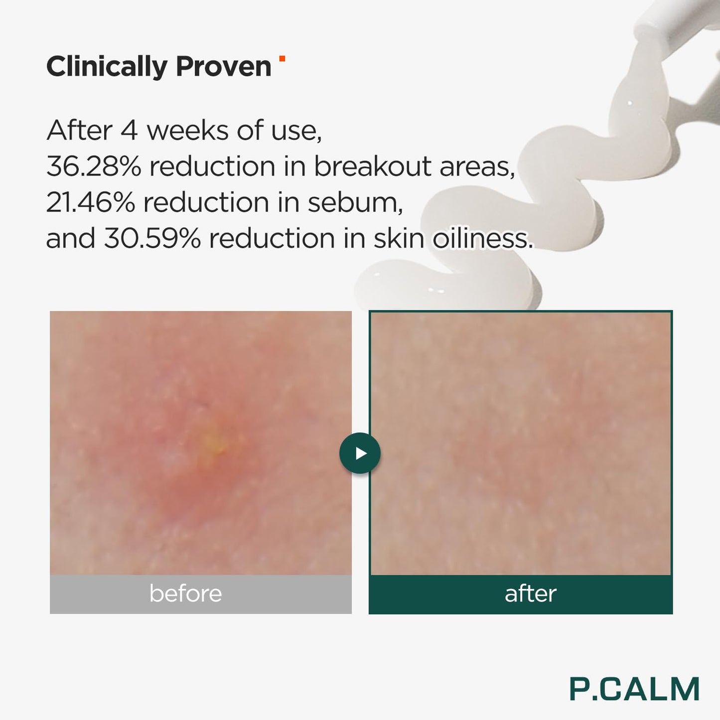 P.CALM Centella Trouble Spot 0.5 fl.oz | Vegan Trobuble Spot Relief Cream for Sensitive Skin | Korean Skincare