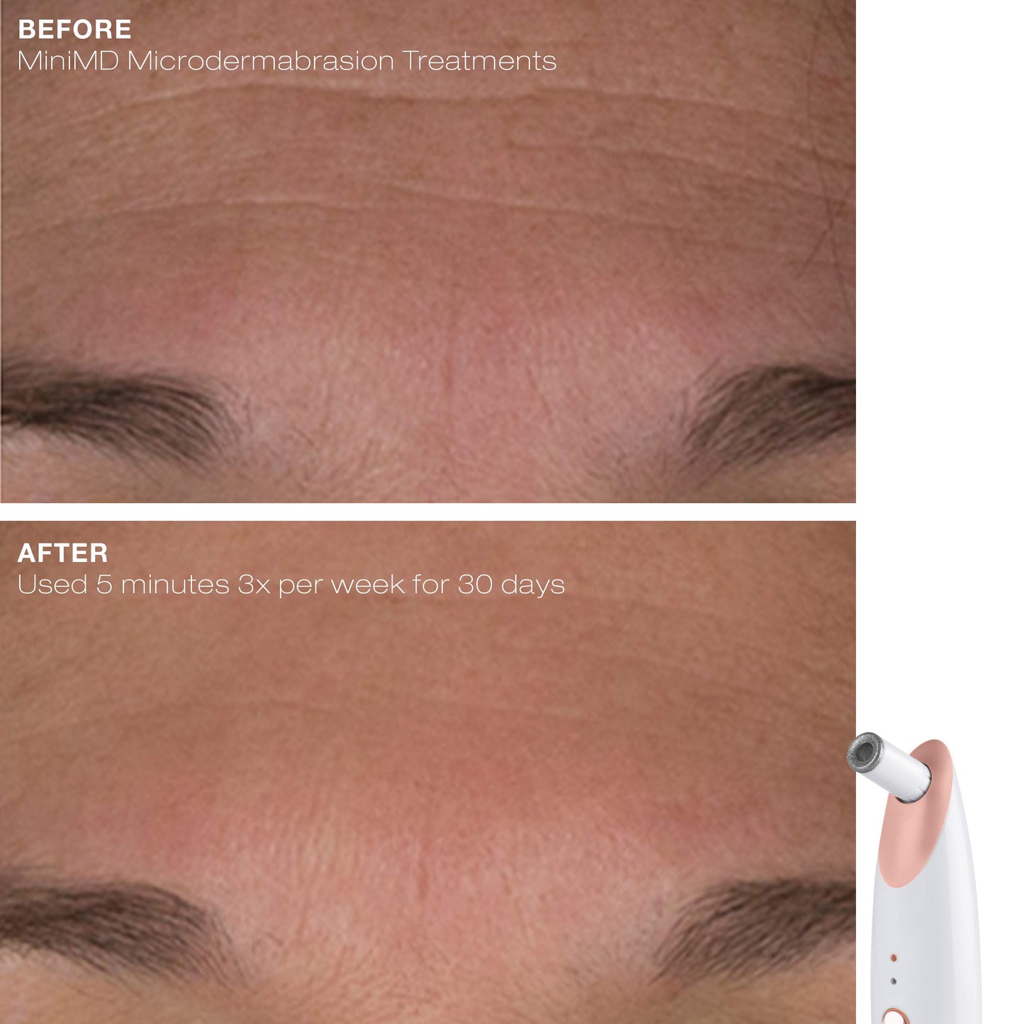 Trophy Skin MiniMD - Mini Handheld Microdermabrasion System - Improves Texture and Skin Tone