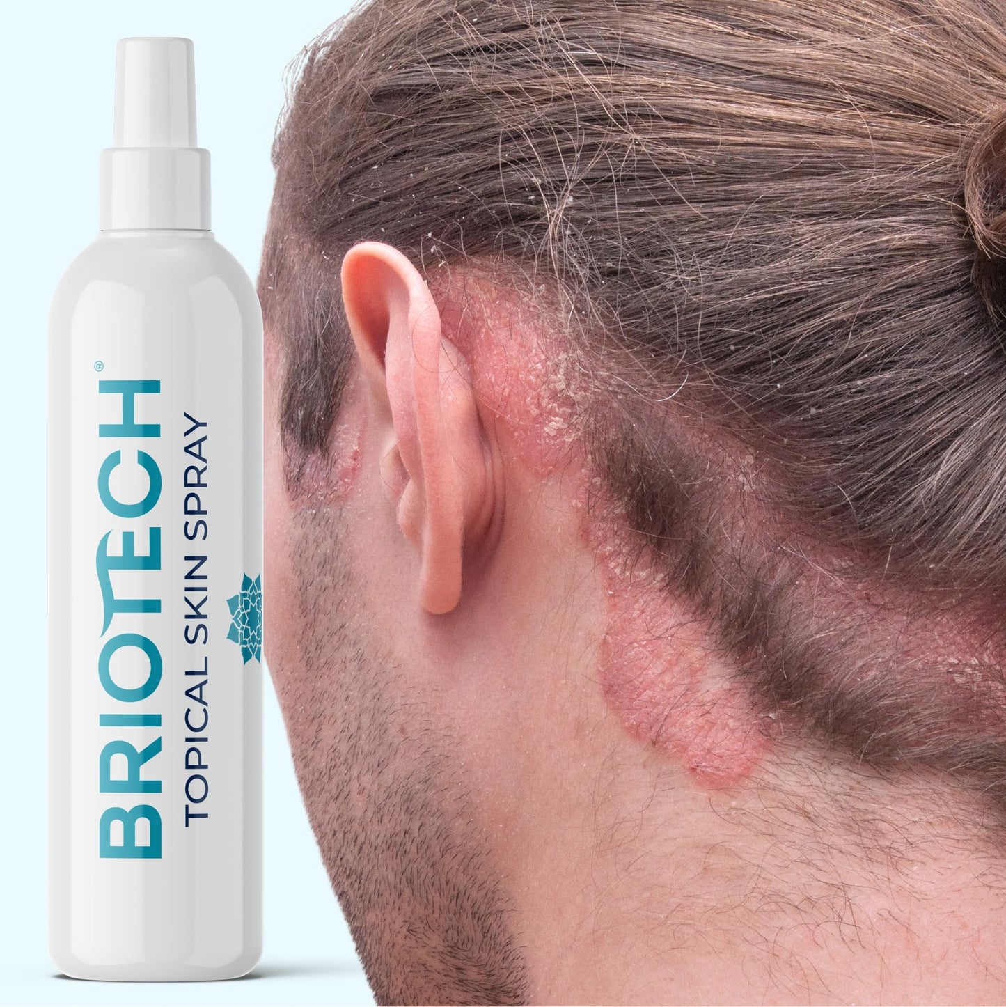 BRIOTECH Topical Skin Spray, Hypochlorous Acid Spray for Body & Face, Eyelid Cleanser, HOCl Facial Mist, Support Against Irritation, Calm Redness, Soothe Scalp, Packaging May Vary, 3.4 oz ea, 2 ct